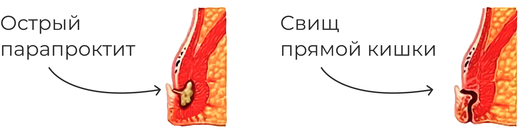 Схема осложнений